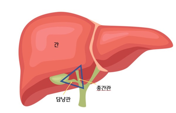 담낭절제삼각 위치 (삼각형 내 구조물)